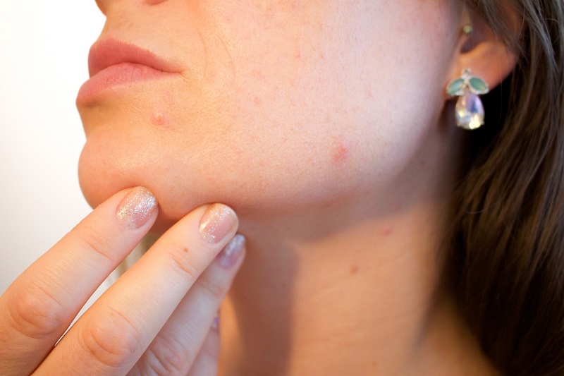 יעילותו של ה-CBD לטיפול בפצעי אקנה על עור הפנים