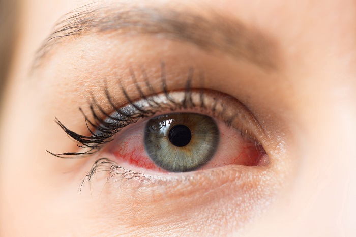טיפול טבעי בדלקת עיניים באמצעות CBD